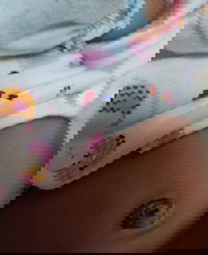 สายสะดือหลุด แต่ยังมีก้อนหนองอยู่