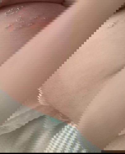 What is this on inner thigh of baby?