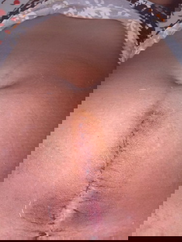 Cesarean Scars.