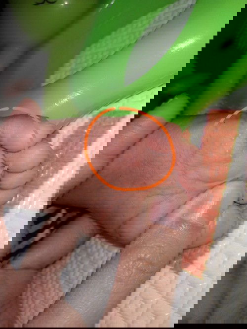 Dermatitis Dishidros