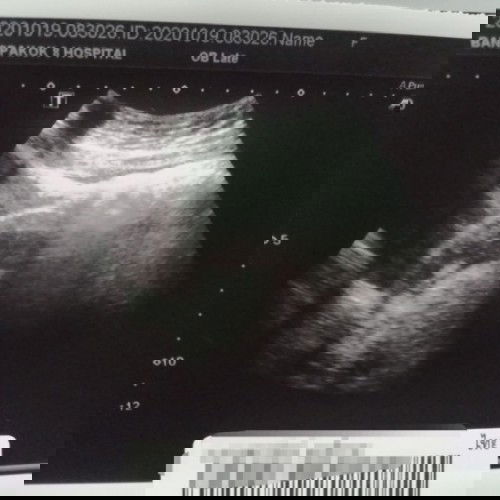 ผลอัลตร้าซาวด์​