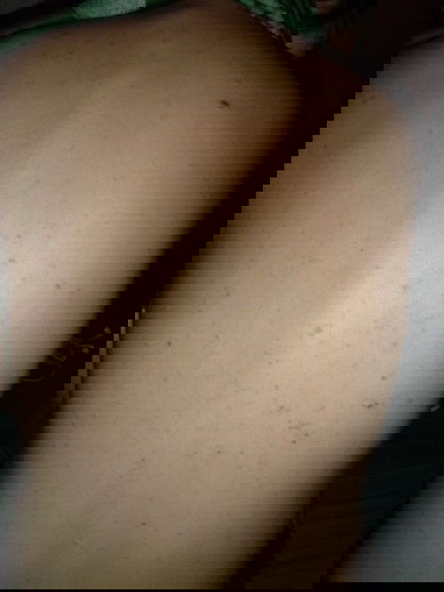 butlig? rashes? bungang araw?