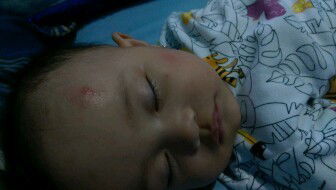 Cream gigitan nyamuk