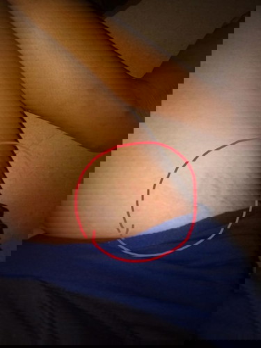 Bakit po ako meron sa legs neto.
Normal po bah toh meron po ako nyan left andc right legs