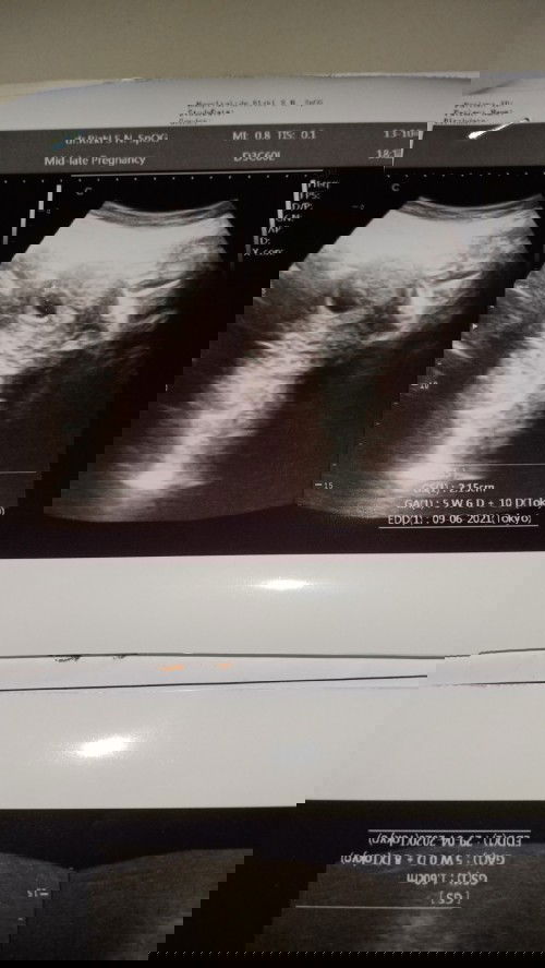 Ukuran kantung pada hamil 5w6d ukuran nya 2.15 cm apakah normal bunda🙏