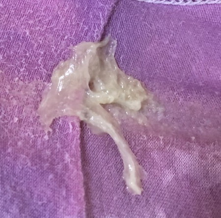 Vaginal Discharge