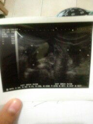 Woryy krna kantung janin belum terlihat !!!