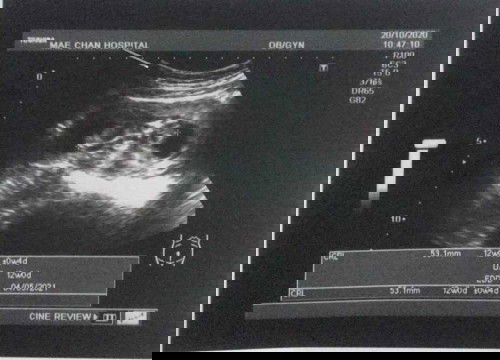 ดูไม่ออกค่ะ อันไหนส่วนไหนของลูกคะหมอไม่ได้บอก