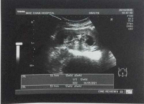 ดูไม่ออกค่ะ อันไหนส่วนไหนของลูกคะหมอไม่ได้บอก