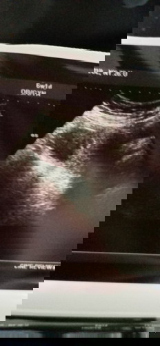 bun sya mau tanya kehamilan sya baru 4 minggu tpi usg ada dugaan ada miom bahaya gak iya kira2.?