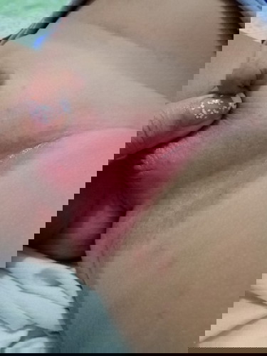 Rashes
