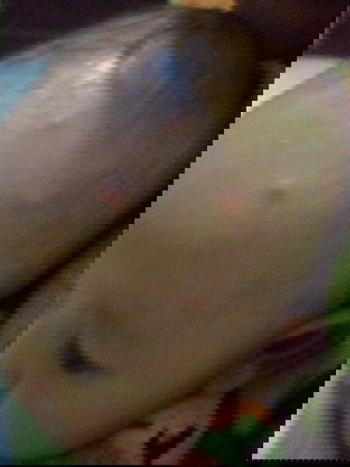 Bentol seperti jerawat