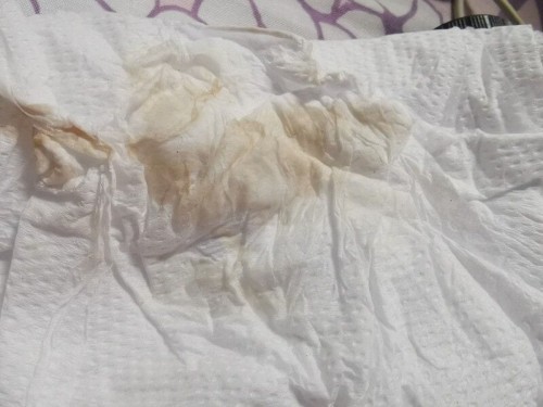 แม่บ้านไหนมีตกขาวสีน้ำตาลอ่อนมีปวดท้องคล้ายประจำเดือนแต่ไม่มาก อันตรายมั้ย
แม่ท้อง7สัปดาห์6วัน