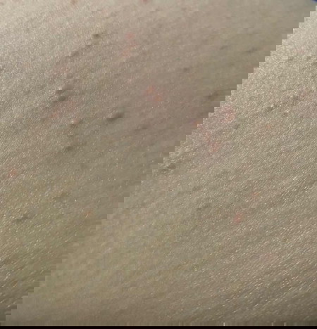 Bumps on Thigh/Tummy