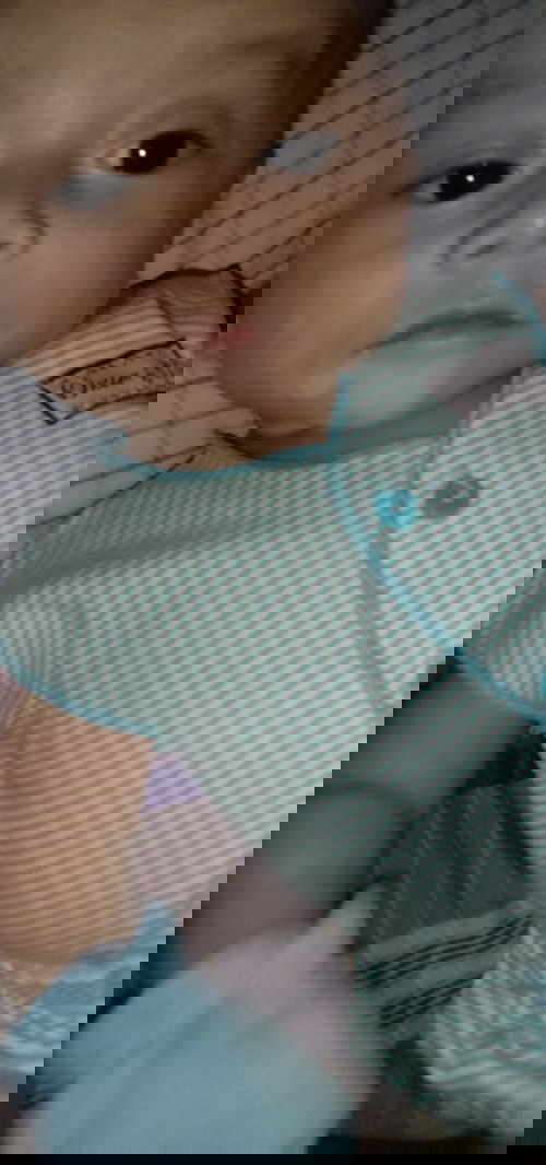 Bercak putih bekas ruam susu