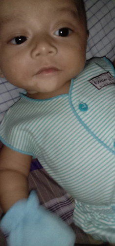 Bercak putih bekas ruam susu