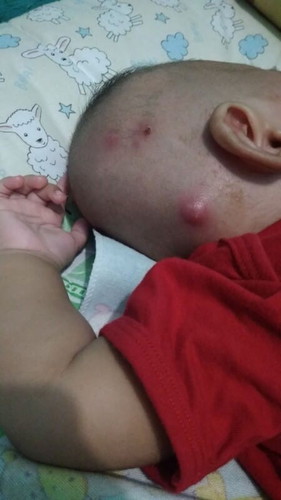 bisul pada bayi