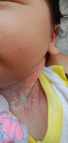 Assalamu’alaikum bunda"
Minta solusiny bun, anak sya ad ruam merah(putih"ny bedak)dibagian leher