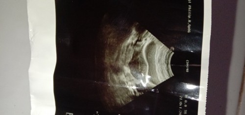 Pendarahan berakhir keguguran