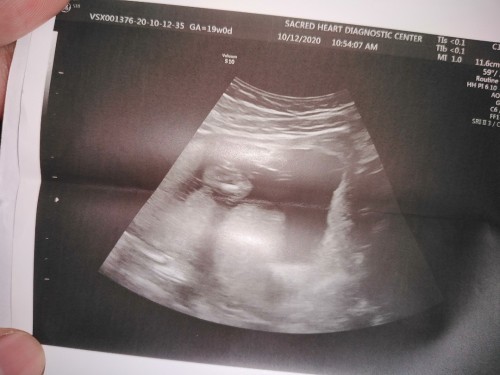 Babae or lalaki? Babae daw kasi sabi ng ob ko, how to determine if babae?