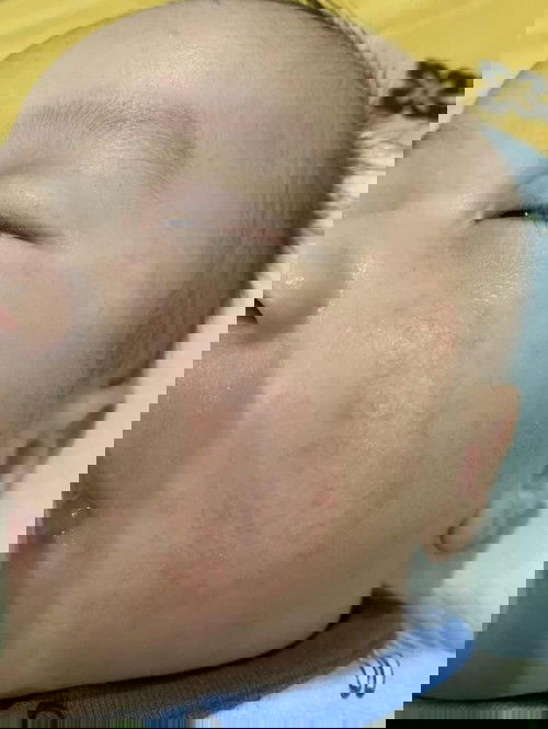 Chữa tràm cho bé