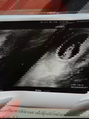 7W 5d หมอบอกว่าน้องแข็งแรงดี