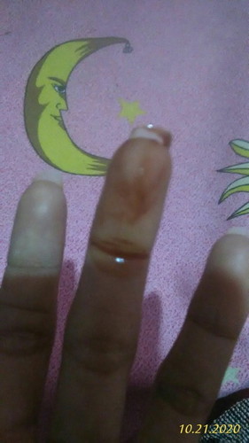 Keluar flek coklat smcam lagi haid tpi gak bau darah.. kira" itu gejala normal apa gmna ya... info n