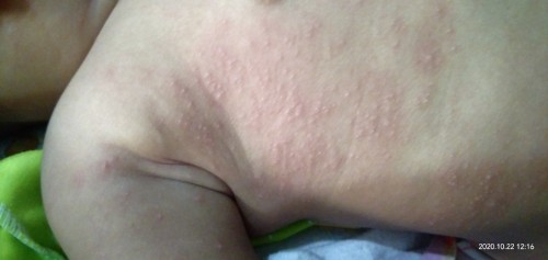 Ruam pada kulit bayi