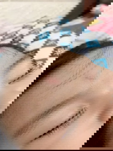 Scratch on her face