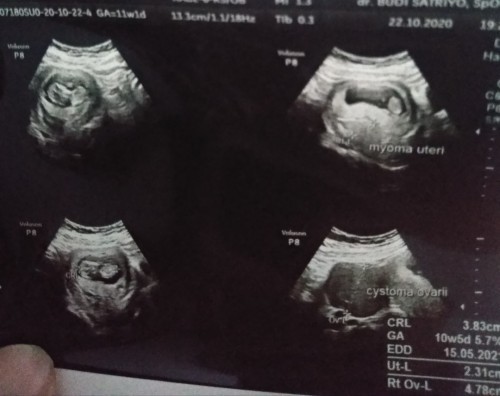 Hamil ada kista dan miom
