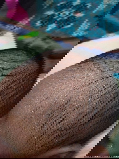 Bruntusan di sekitar kepala