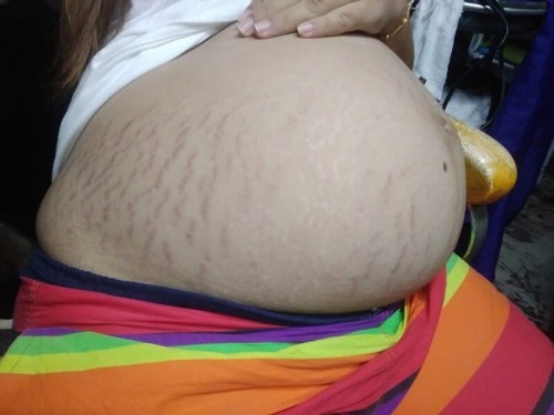 ท้องแตกลาย