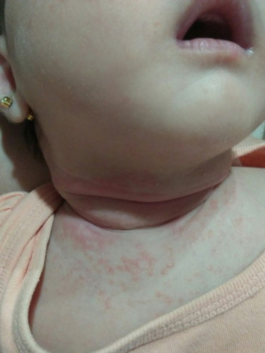 Neck Rash....