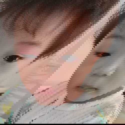 ลูกโดนยุงกัดที่เปลือกตาคะ บวมตุ่ย ทำไงดีคะ