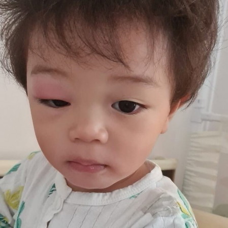 ลูกโดนยุงกัดที่เปลือกตาคะ บวมตุ่ย ทำไงดีคะ