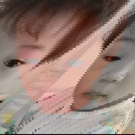 ลูกโดนยุงกัดที่เปลือกตาคะ บวมตุ่ย ทำไงดีคะ