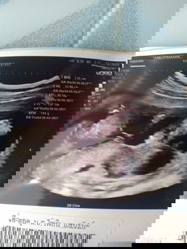 แม่เป็นพาหะธาลัสซีเมียอันตรายมากหรือป่าว