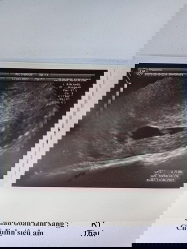 Có mom nào thai được 5w4d có tim thai rồi nhưng nghe còn yếu không ạ? Em thấy lo quá ạ.