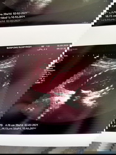 5เดือนเเล้วปวดหลังมากๆ นอนเอีวงข้างช่วยได้จริงไหมค่ะ?