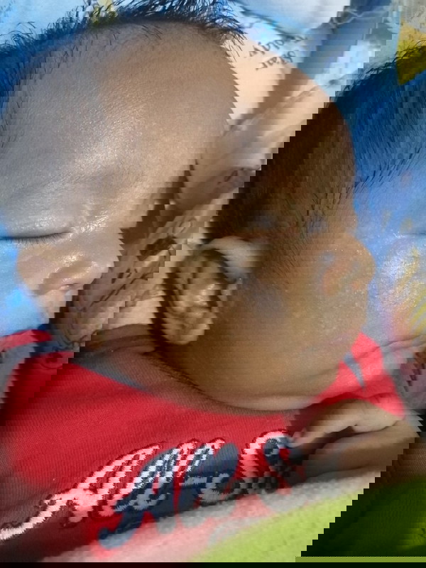 White Small Patches on Baby's Face Hello mga mamsh, tanong k