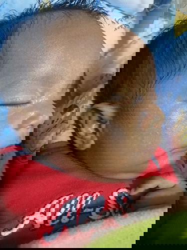White Small Patches on Baby's Face