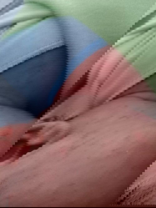 bintik bintik merah di wajah bayi