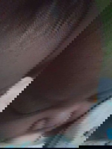 ผดขึ้นหน้าผากน้องคืออะไร