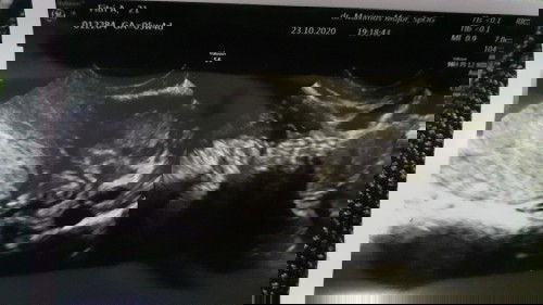 Usg 5w penebalan rahim