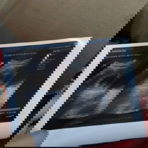 Hasil USG 9w6d, ada yang sama Bun?