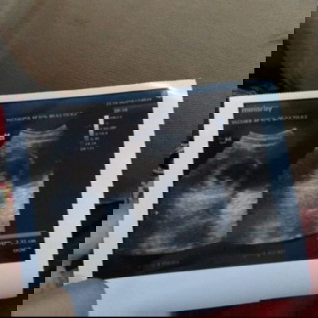 Hasil USG 9w6d, ada yang sama Bun?