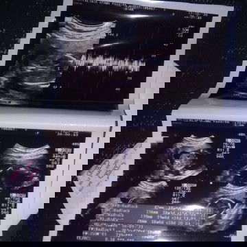 Jenis kelamin baby & USG 4D