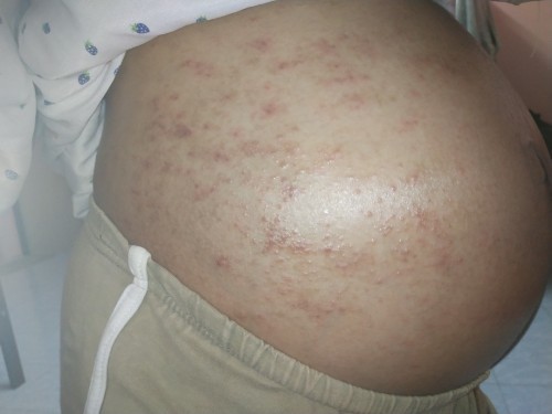 ผื่นที่หน้าท้องอันตรายมัยค่ะ