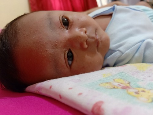 muka beruntusan