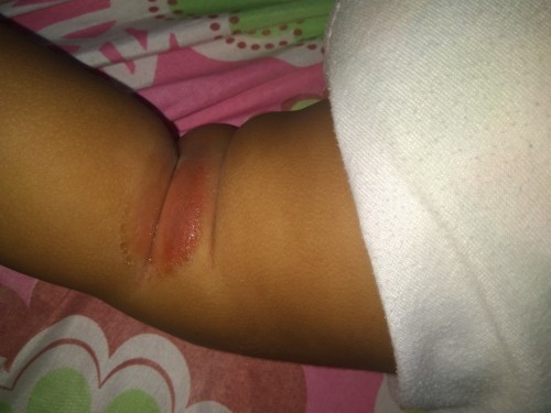 Pa help namn po, ano po kayang mabisang gamot sa gantong rashes ng baby. Tnx in advance 😊